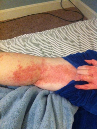 This. This was all over my body, front and back. This is several hours after steroids had been administered.